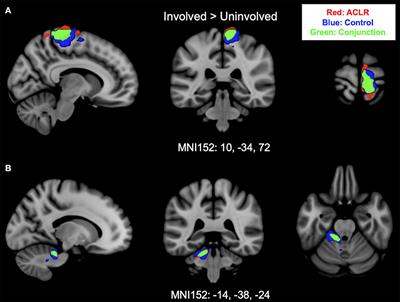 Organization of sensorimotor activity in anterior cruciate ligament reconstructed individuals: an fMRI conjunction analysis